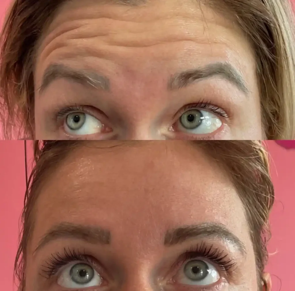Tox for forehead lines before and after results at Evolution Aesthetics in Freeland, MI