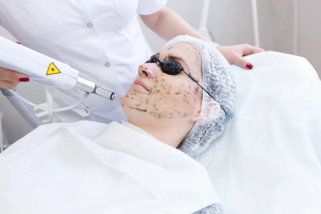 Pico Laser Treatment in Freeland MI at Evolution Aesthetics